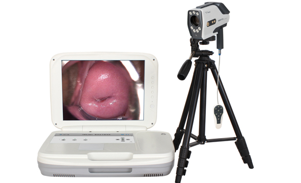 電子陰道鏡主要是檢查什么的