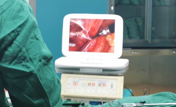 宮腔鏡和腹腔鏡有什么不同？