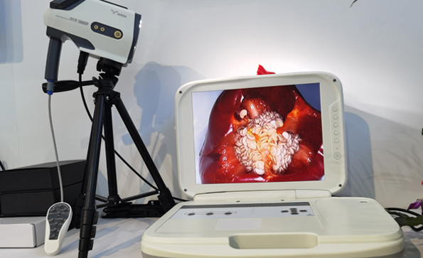 陰道鏡：在陰道鏡下如何做宮頸囊腫？