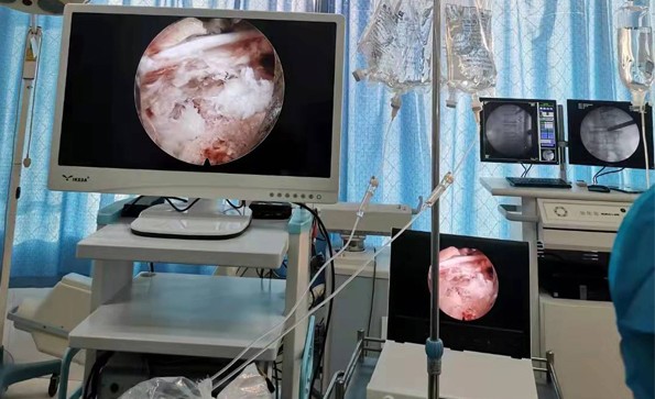 椎間孔鏡的基本配置有哪些？有哪些優(yōu)勢？